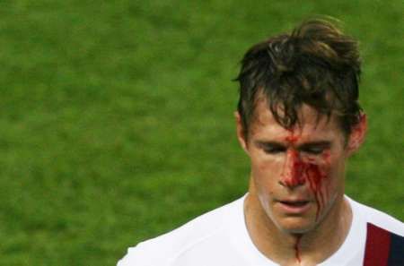 الإمريكي بريان مكبرايد دمائه تنزف بعد ضربة الإيطالي دانييلي دي روسي 