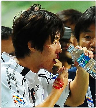 كيم بو كيونج يتعرض للنزيف في أنفه المكسور