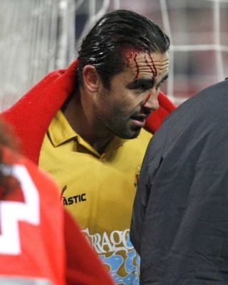 مدافع خيمناستيكا كارليس منجو والدماء تغطي وجهه في لقاء فريقه مع اتلتيكو مدريد