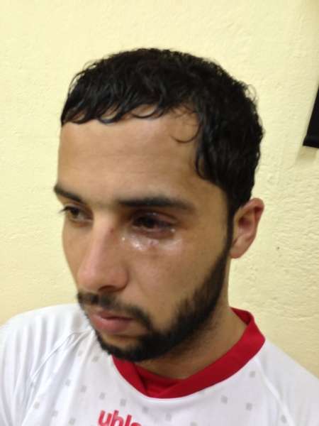 الظهير الايسر ابو جزر واثار الضربة على عينه