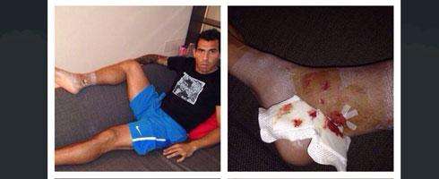 tevez-ankle