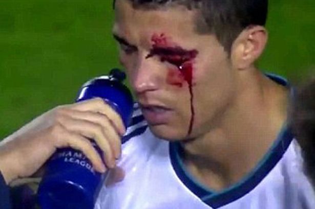Cristiano%20Ronaldo''s%20eye%20injury